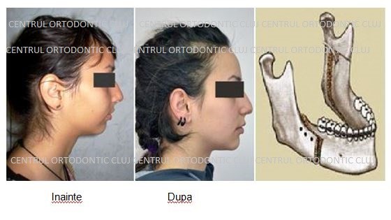 Tratamente ale Articulatiei Temporo-Mandibulare - Centrul Ortodontic Cluj
